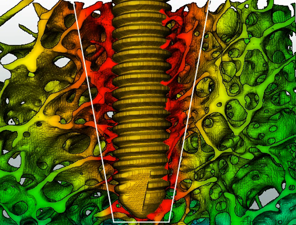 Enlarged view: Figure 1: A Finite Element model of a screw in cancellous bone.