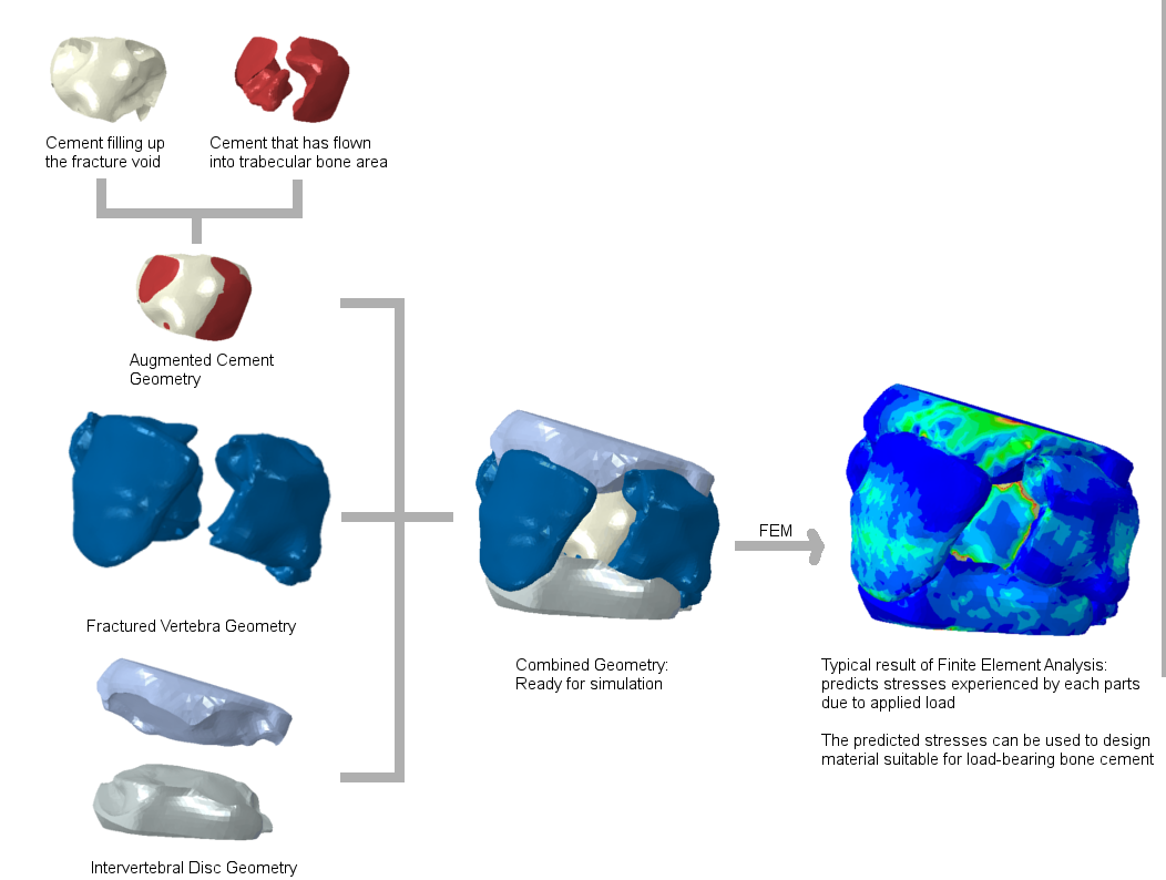 Enlarged view: Figure 1: Simulation work flow for a fractured vertebra augmented with bone cement.